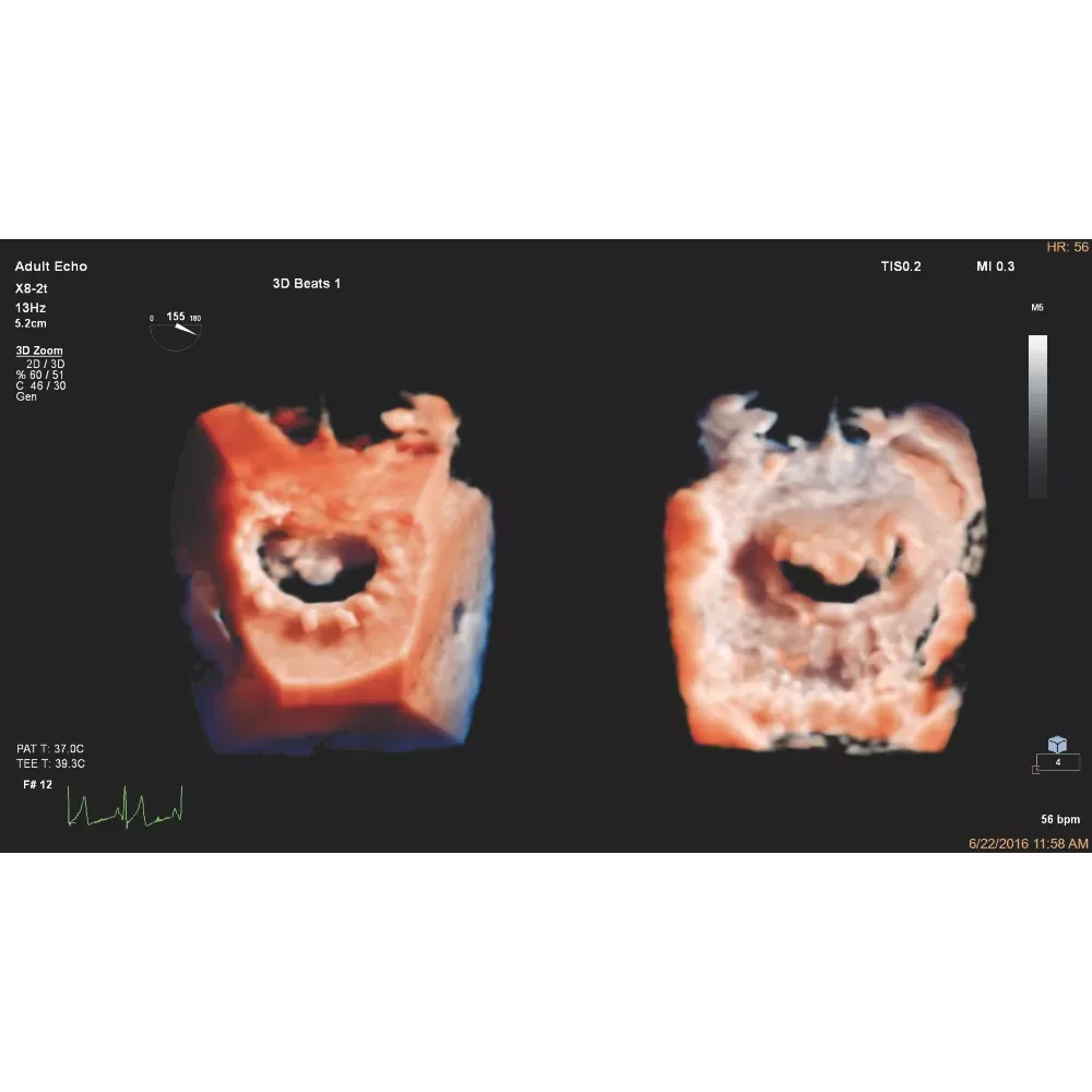 Philips EPIQ CVx ультразвуковой аппарат Philips EPIQ CVx ультразвуковой аппарат