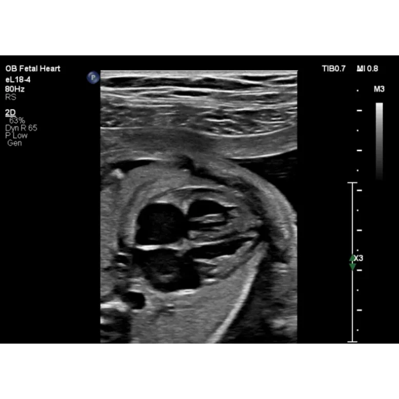 Philips EPIQ CVx ультразвуковой аппарат