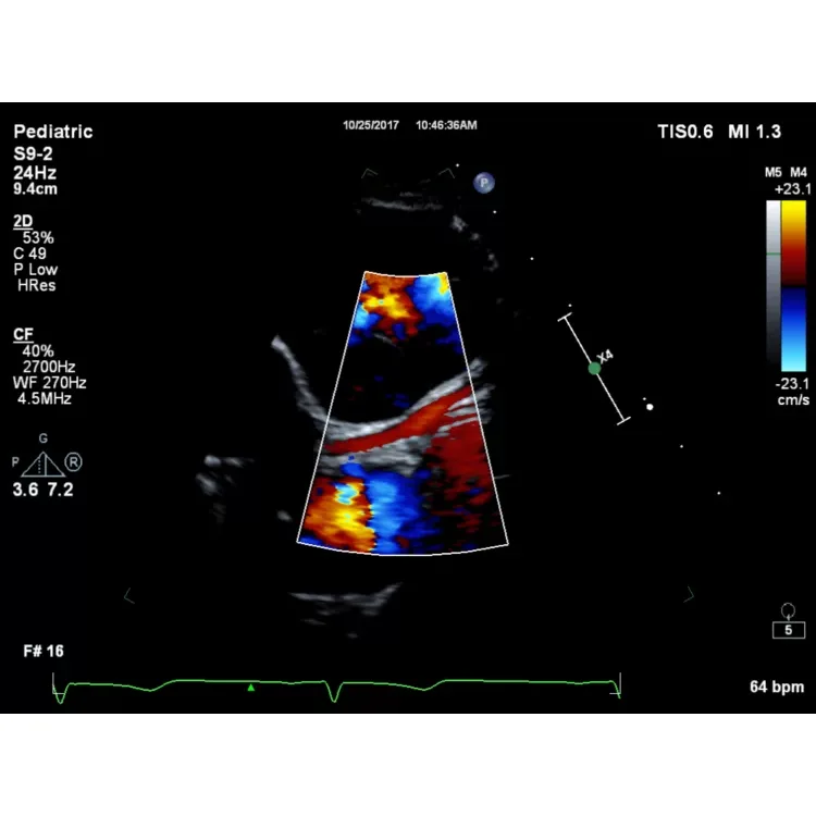 Philips EPIQ CVx ультразвуковой аппарат Philips EPIQ CVx ультразвуковой аппарат