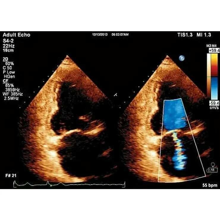 Philips Affiniti 30 ультразвуковой аппарат