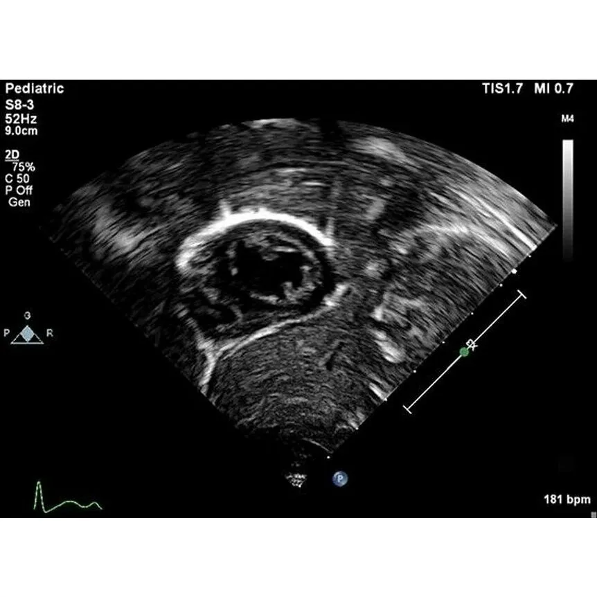 Philips EPIQ 5 ультразвуковой аппарат Philips EPIQ 5 ультразвуковой аппарат