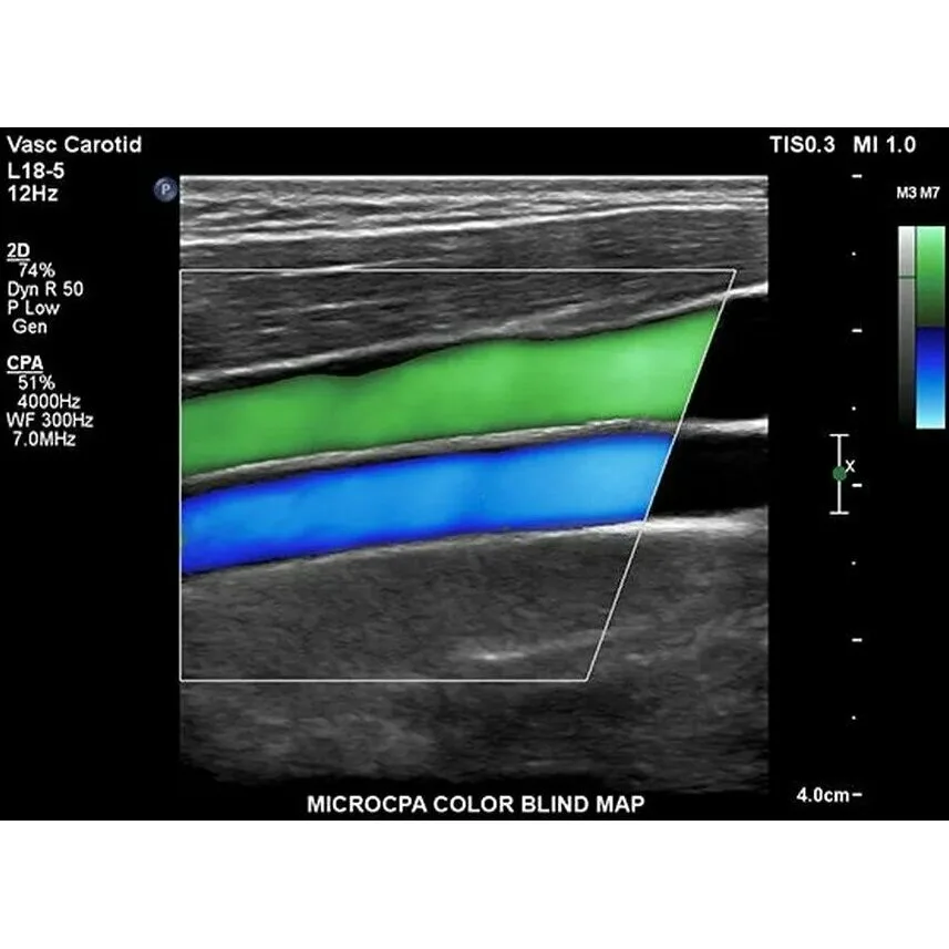 Philips EPIQ 5 ультразвуковой аппарат Philips EPIQ 5 ультразвуковой аппарат