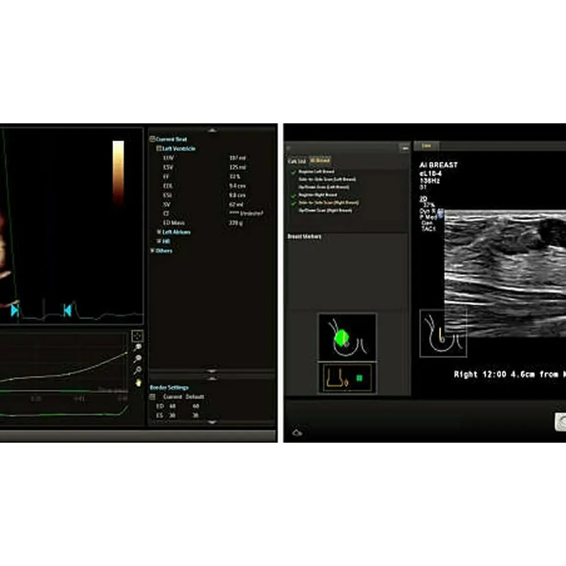 Philips EPIQ Elite ультразвуковой аппарат Philips EPIQ Elite ультразвуковой аппарат